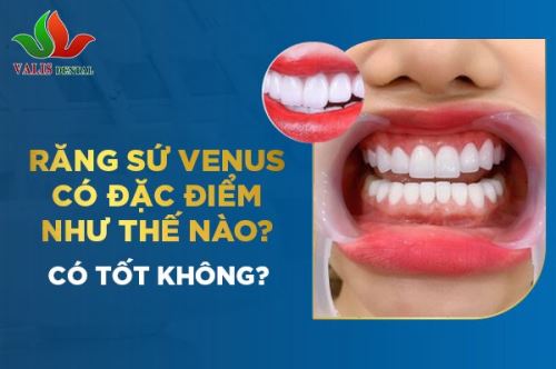 RĂNG SỨ VENUS CÓ ĐẶC ĐIỂM NHƯ THẾ NÀO? CÓ TỐT KHÔNG?