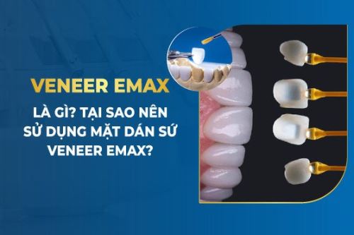 Veneer Emax Là Gì? Tại…