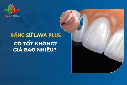 Răng Sứ Lava Plus Là…