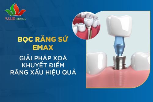 Bọc răng sứ Emax –…