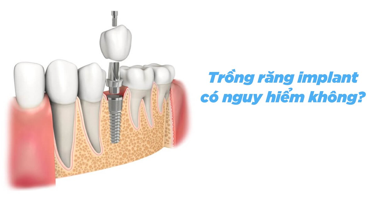 Cấy ghép Implant có an toàn không