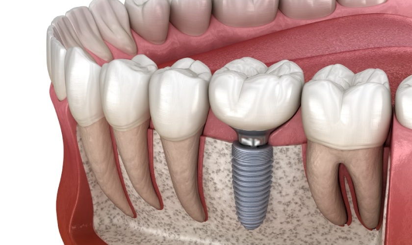 Cấy ghép Implant