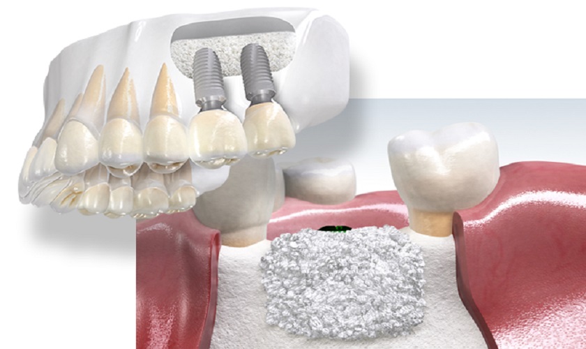 Xương hàm đóng vai trò như nền móng vững chắc để giữ trụ Implant cố định và ổn định