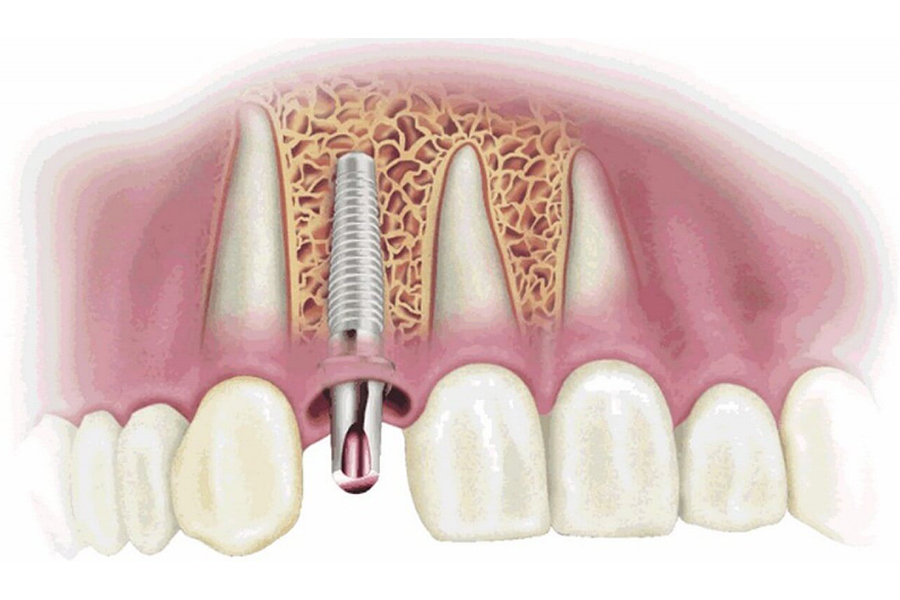 Nguyên nhân cấy ghép implant thất bại