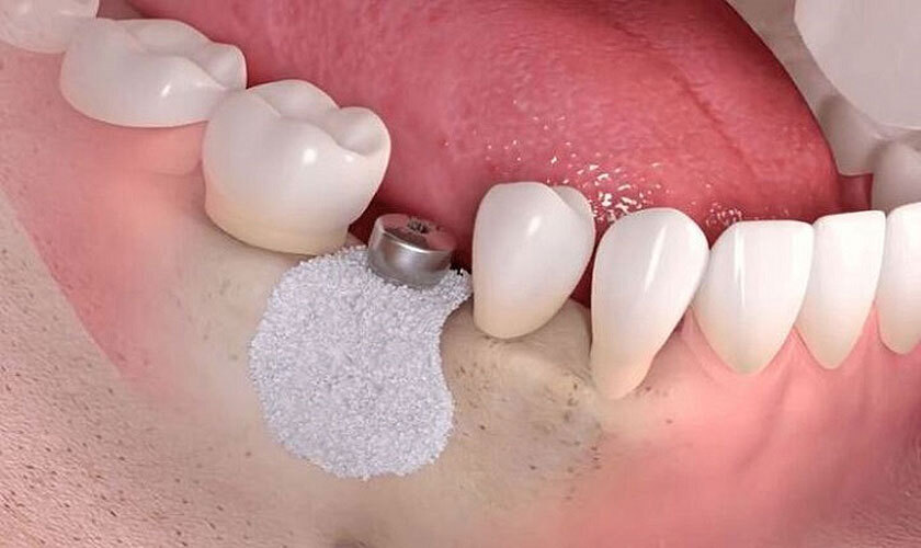 Để biết đủ điều kiện cấy ghép Implant thì làm thế nào