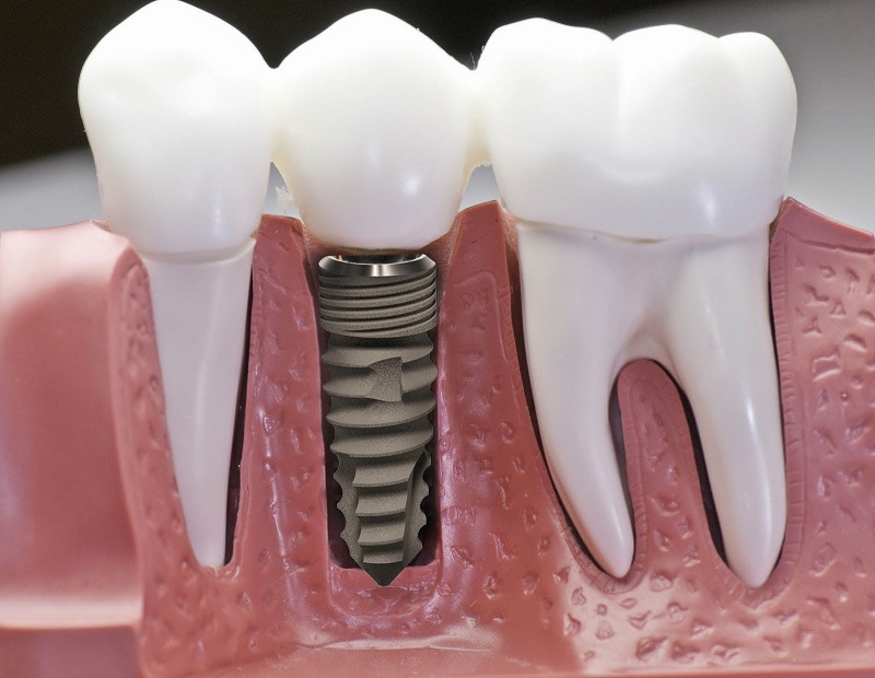 Cấy ghép Implant - phương pháp phục hồi răng mất bằng cách cấy một trụ titanium vào xương hàm để thay thế cho chân răng đã mất