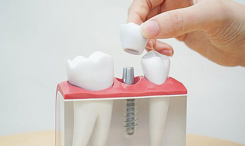 Răng Implant có thể bị sâu hoặc cần điều trị tủy không?