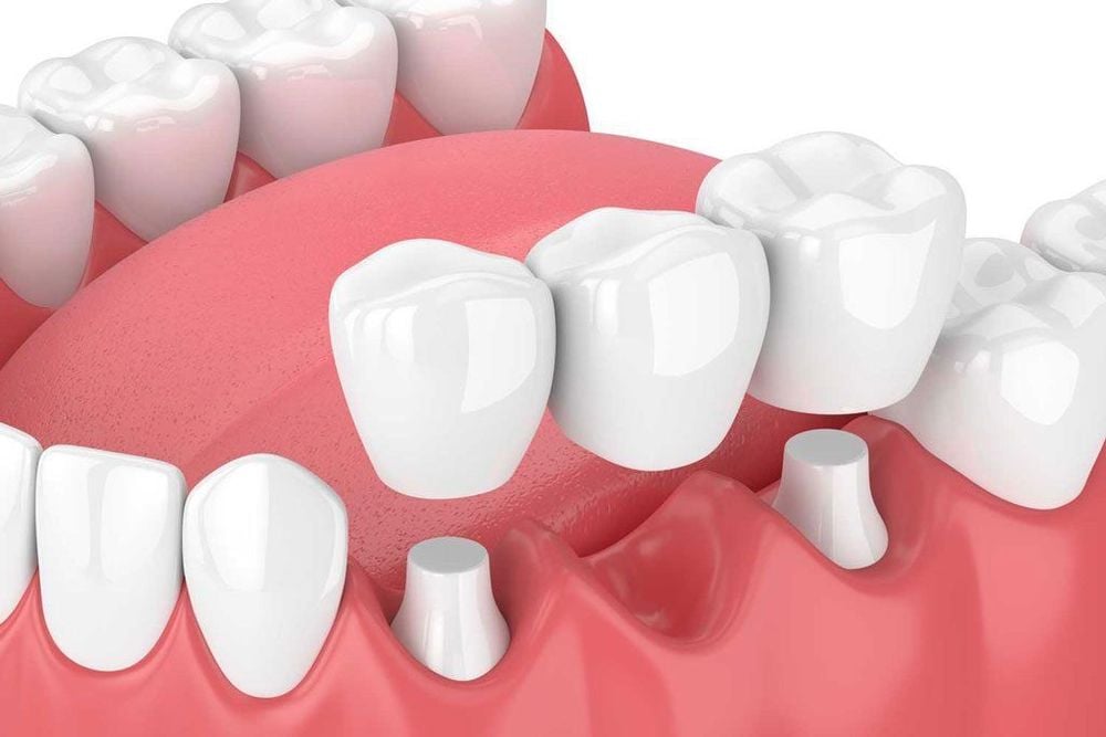 Sự khác biệt giữa Implant và cầu răng sứ là gì?