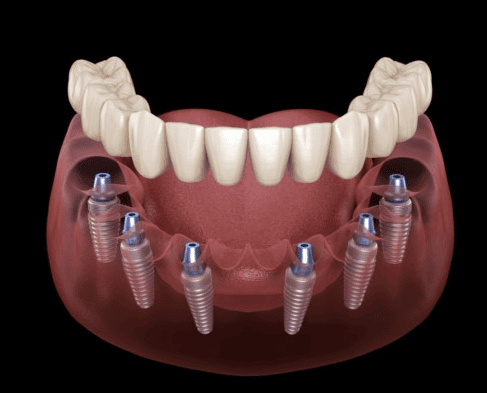 Thời gian lành thương sau khi cấy ghép Implant là bao lâu?