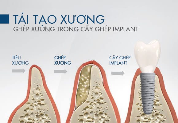 Tái tạo xương: Ghép xương trong cấy ghép Implant