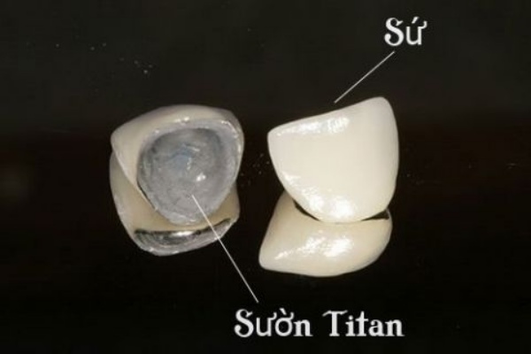 Răng sứ Titan