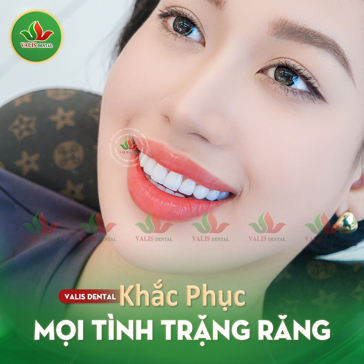 Răng sứ mới được gắn chắc chắn và điều chỉnh để phù hợp hoàn hảo với hàm răng của bạn.