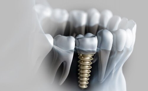 Cấy ghép Implant