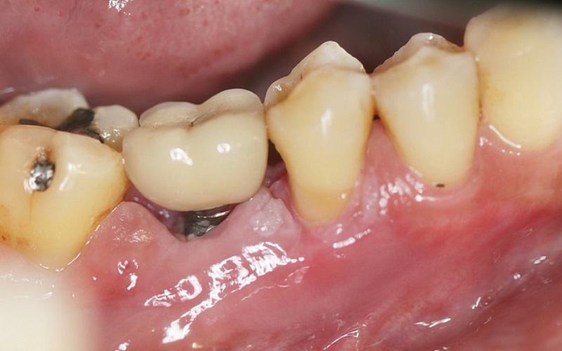 Viêm lợi quanh Implant