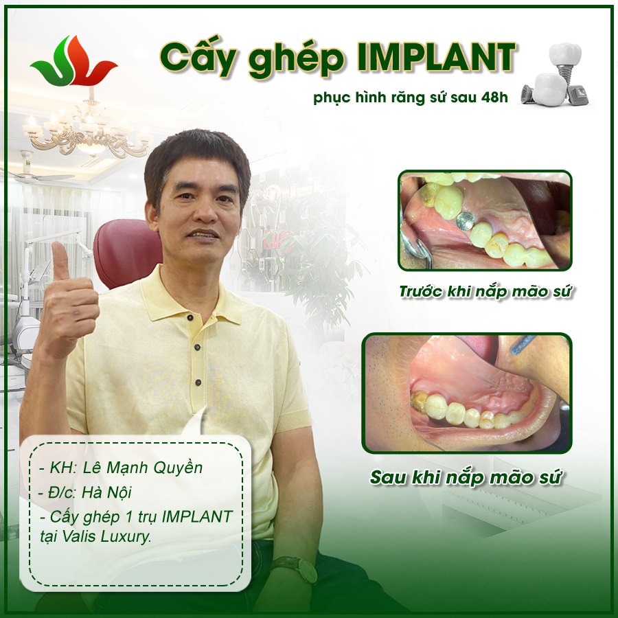 Nha khoa Valis – Địa chỉ chăm sóc và cấy ghép Implant uy tín