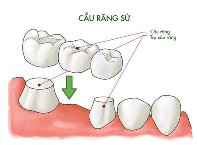 Cầu răng sứ - phương pháp phục hồi răng mất bằng cách tạo ra một chiếc cầu được gắn lên hai răng bên cạnh răng mất