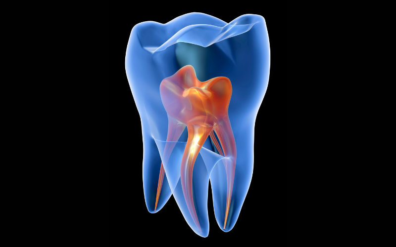 Phương pháp tẩy trắng răng chết tủy