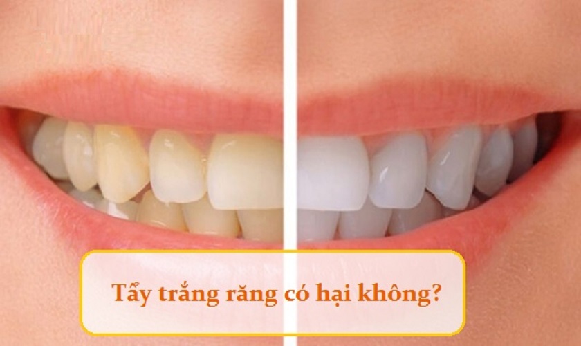 Tẩy trắng răng có gây hại không? Cụ thể tác hại khi tẩy trắng răng là gì?