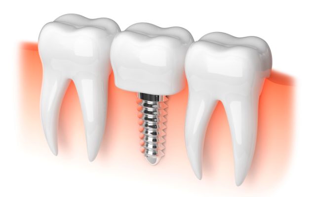 What Are the Different Types of Dental Implants? – Valis Dental Guide