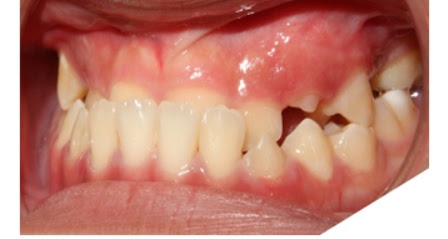 Dấu hiệu nhận biết khi có vấn đề về khớp cắn