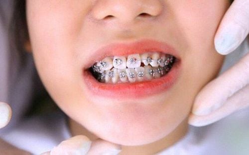 Niềng răng sớm là cách làm thông minh để có được khớp răng hoàn chỉnh