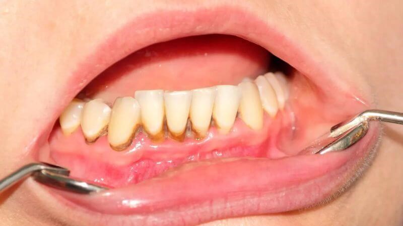 Cao răng là mảng bám cứng chắc ở chân răng và dưới lợi