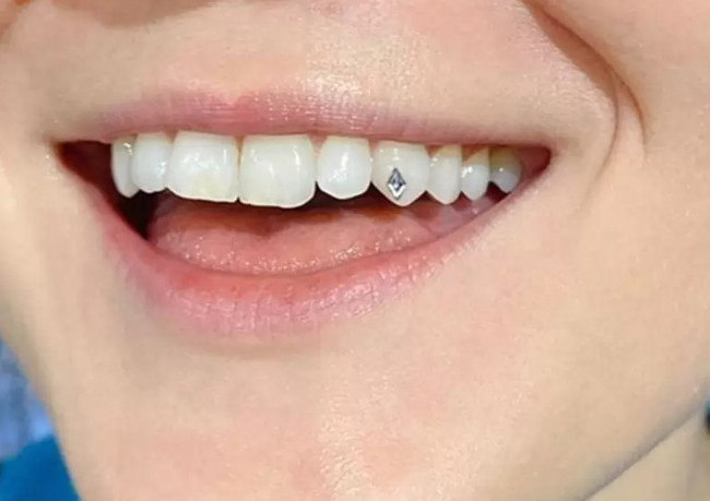 Đính kim cương lên răng làm tăng vẻ đẹp của răng