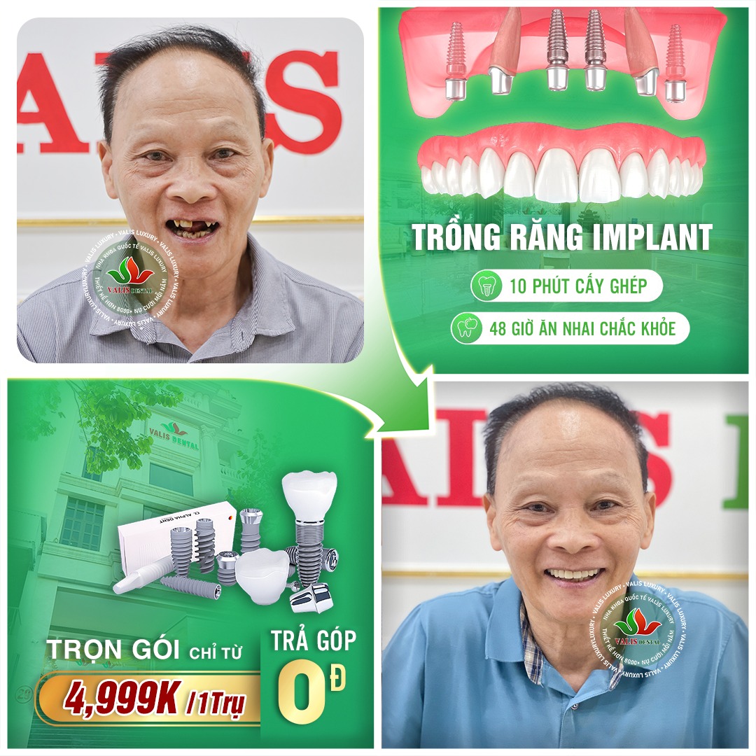 Trồng răng Implant là cách giúp chắc khỏe và lâu dài
