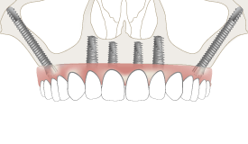 Răng Implant có bị sâu không? Giải đáp từ chuyên gia nha khoa Valis