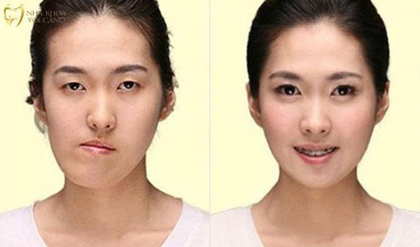Chewing on One Side Causes Facial Asymmetry – The Silent Danger of a Seemingly Harmless Habit