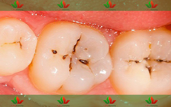 How Cavities Start: Early Signs & Effective Prevention