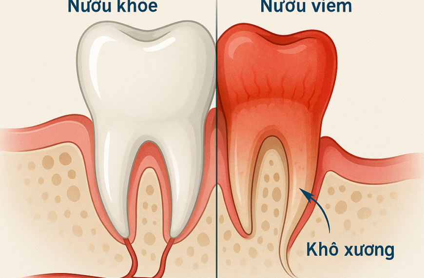 Tiểu đường có dễ bị bệnh nướu không? Bác sĩ Nha khoa Valis cảnh báo nguy cơ tiềm ẩn