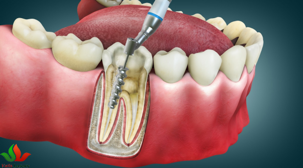 What Is Root Canal Treatment and When Do You Need It