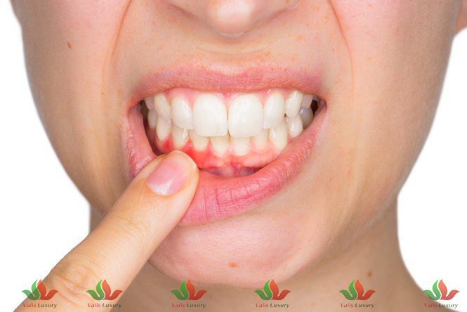 Viêm nướu không chữa – Mối nguy âm thầm đe dọa sức khỏe răng miệng của bạn