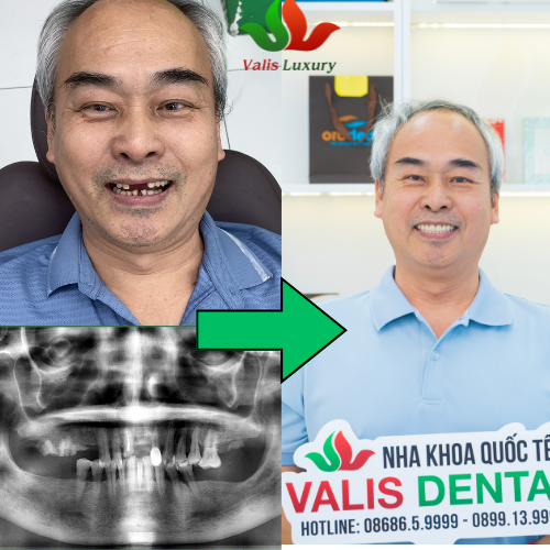 Restore Your Smile After Years of Tooth Loss – Advanced Implant Solutions at Valis Dental Vietnam