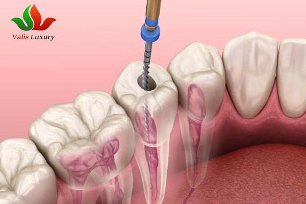 Lấy tủy răng có đau không? Giải đáp từ chuyên gia tại Nha khoa Valis