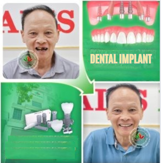 Người Lớn Tuổi Có Nên Cấy Ghép Implant? Lời khuyên từ chuyên gia Nha khoa Valis