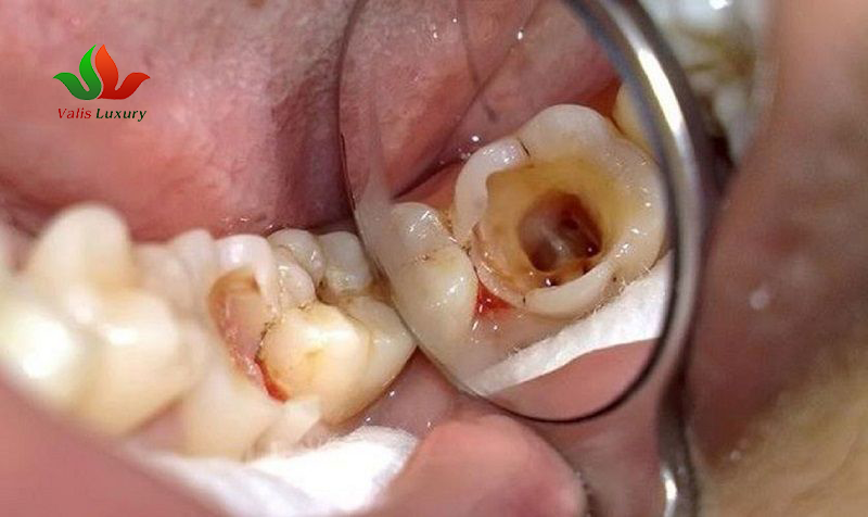 Nguyên Nhân Gây Sâu Răng Và Cách Phòng Ngừa Hiệu Quả