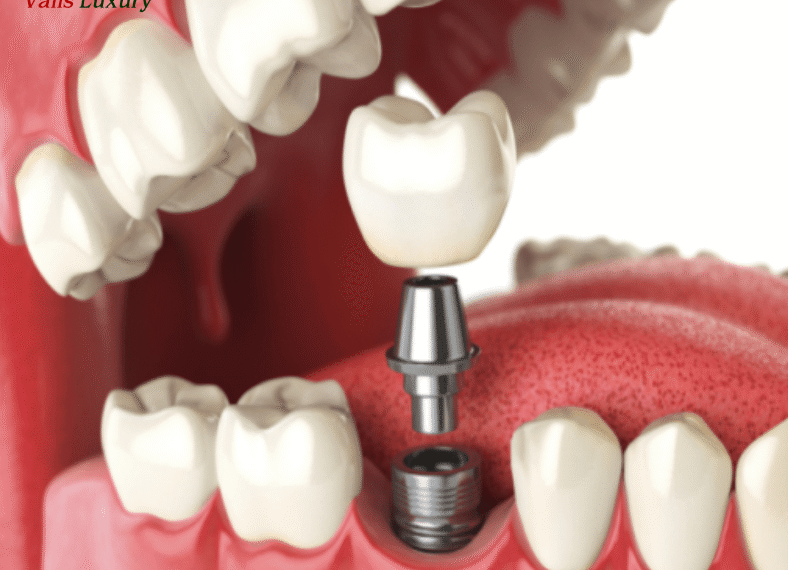 Sau khi cấy Implant nên ăn uống ra sao? Bác sĩ Valis hướng dẫn chi tiết