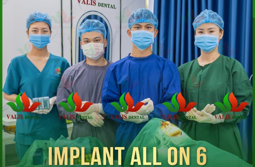 All On 6 – Giải Pháp Phục Hình Toàn Hàm Tại Valis Group