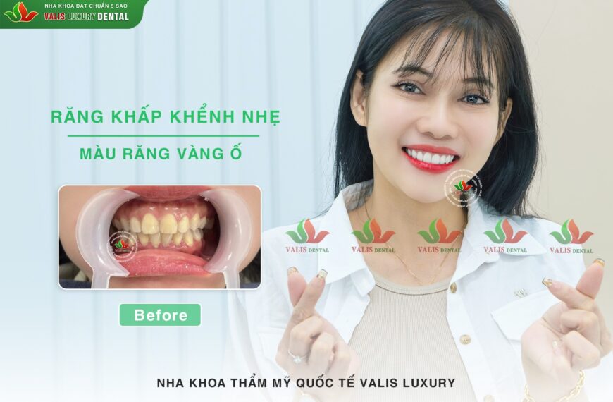 Valis Group – Nâng Tầm Nụ Cười Với Dán Sứ Veneer Cao Cấp