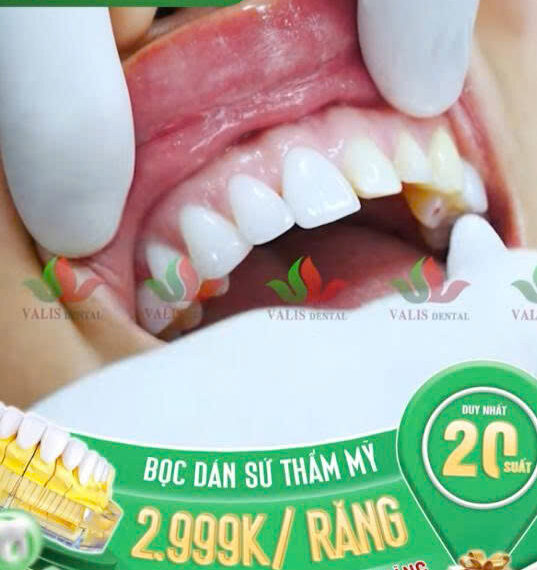 Bọc Răng Sứ Toàn Phần Đức Chỉ 2.999k/Răng – Ưu Đãi Đặc Biệt Tại Valis Dental–Valis Group