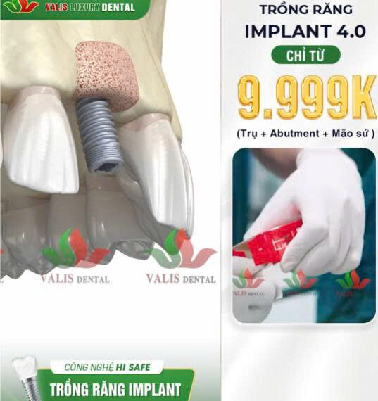 Vì Sao Nên Chọn Trồng Răng Implant Tại Valis Dental – Valis Group?